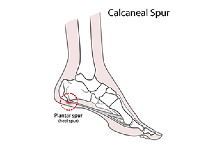 Heel Spur Treatment - Moore Foot & Ankle | Spring, TX