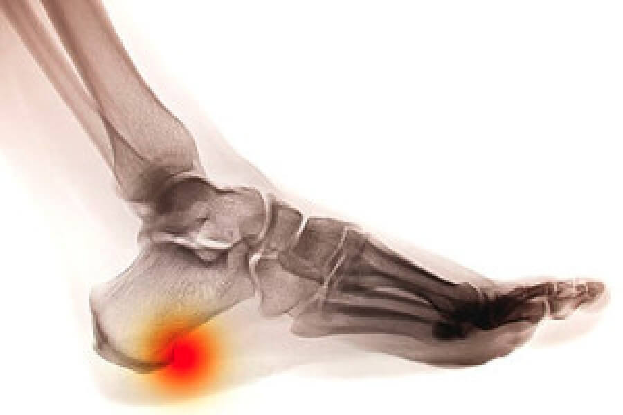 Physical Therapy for Plantar Fasciitis and Heel Spurs