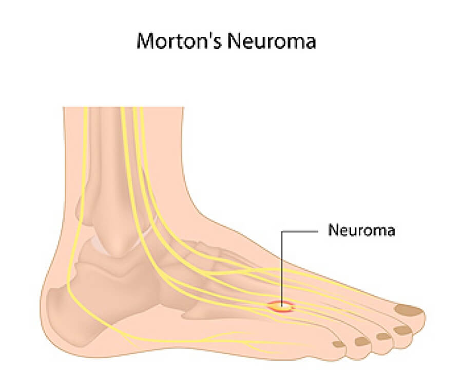 Burning Sensation in the Heel: Causes & Treatments - ePodiatrists