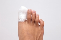 Severe or Mildly Broken Toes