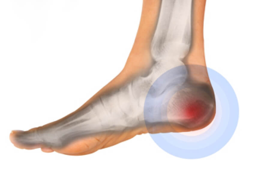 Symptoms and Conditions - Ankle Pain – DrScholls